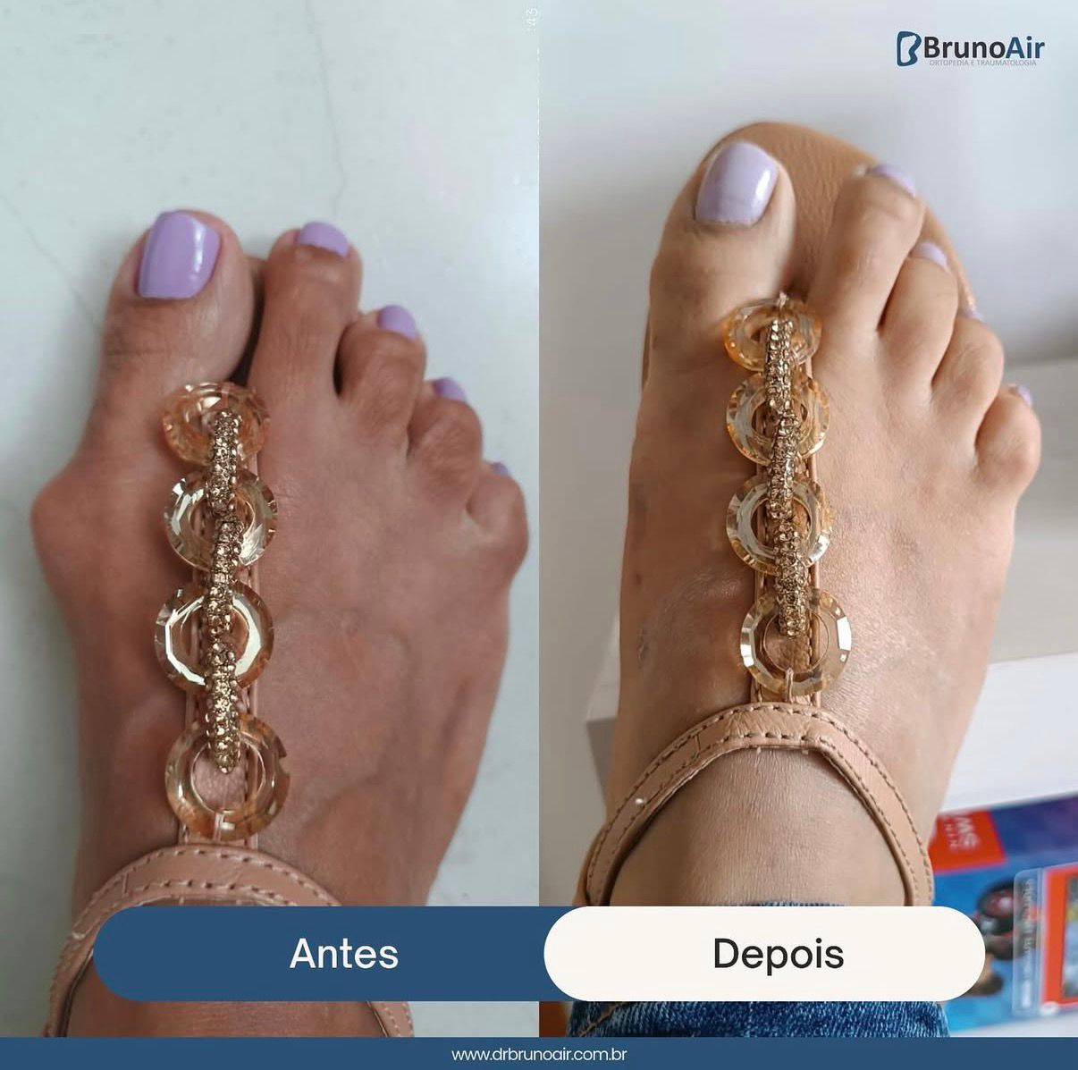 Resultado de tratamento de joanete